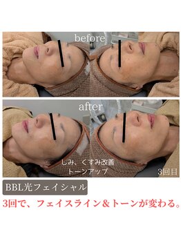 ティンクル サロン(Twinkle salon)/BBL光/くすみ改善で透明感肌