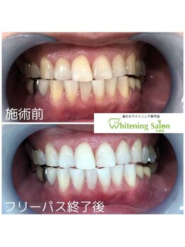 ホワイトニングサロン 札幌店/【ホワイトニング】#札幌#大通り