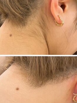 ノフ 恵比寿(noff)/うなじ脱毛