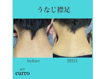 アクト クロ(ACT curro)/【うなじ襟足】脱毛施術例