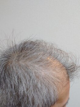 セラフ(Seraph)/頭皮毛髪育毛促進スカルプヘッド