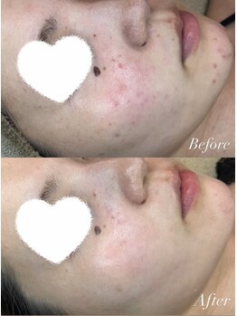 フルール ニコ(Fleur Nico)/3回のBeforeAfter