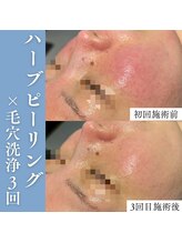 エミーニー(emiiny)/赤み、毛穴の開きに