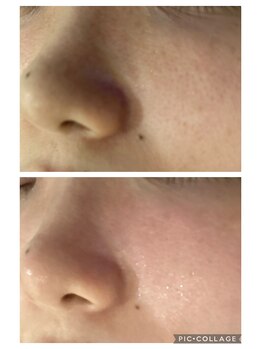 プレシャス(precious)/毛穴綺麗と引き締まり艶々