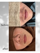 ヒーリングハーツ(Healing Hearts)/メンズヒゲ脱毛！１年間の変化♪