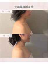 ハチハチ(808)/二回目の変化美容鍼