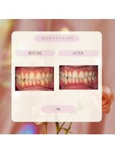 プラスビー 2号店(+b)/ホワイトニングビフォーアフター