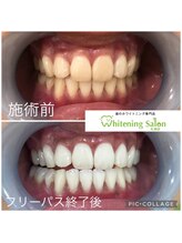 ホワイトニングサロン 札幌店/【ホワイトニング】#札幌#大通り