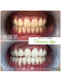 ホワイトニングサロン 札幌店/【ホワイトニング】#札幌#大通り