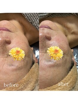 ムム(MooMoo)/ラジオ波+リフティング