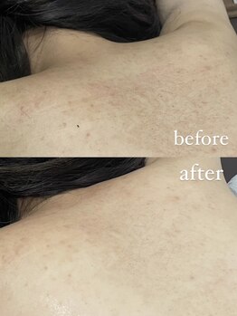 チル(chill)/ビフォーアフター