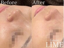 ベル 赤羽(Belle)/ハーブピーリング｜ニキビケア