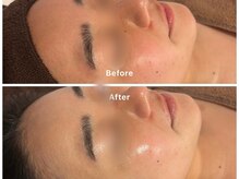 サロンアルーナ(Salon a Luna)/剥離しないハーブピーリング