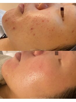 カランコエ(KALANCHOE)/ニキビケア★肌質改善に◎