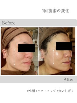 チャーム(Charm)/小顔リフトアップ