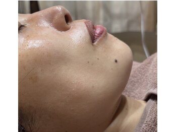 プレシャス(Precious)の写真/ハリつや実感！REVIハーブピーリングで40代～のエイジングケア◎ご新規様15分ヘッドマッサージプレゼント中