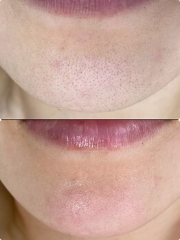 プアラ(puala)/あごもキレイに!