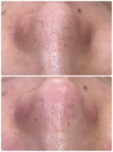 プアラ(puala)/施術後は美容液でツルん