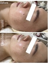 ルルボーテ(Loulou Beaute)/アンストレス×コルギ