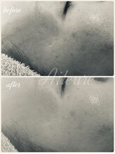 エルール トータルビューティ(Aileure total beauty)/肌質改善　ララピール