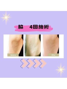アンリール 旭川店(Anrire)/脱毛のビフォーアフターです!