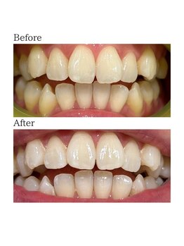 ノーブル 上土店(Noble)/ホワイトニングBeforeAfter