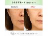 得別【シミお悩みの方】諦めていた頑固シミ根本改善60分LED付¥16500→¥13500