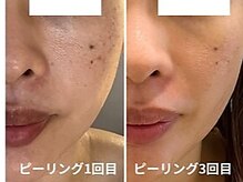 ブルーム(BLOOM)/WISHproビフォーアフター