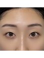 アイスタイル リリーフ(Eye Style Relief)&nbsp;一重瞼もパッチリデザイン