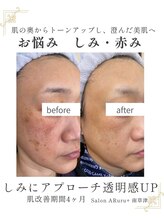 アルルプラス 南草津(ARuru+)/【肌改善】ビフォーアフター