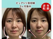 ピュアハリ/沖縄那覇美容鍼灸/たるみ/小顔