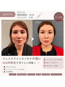 ルアナ(Luana)の写真/【お肉に溶解液をピストルで撃退】即効性！ブルドッグフェイス、小顔に！韓国産の溶解液をピストルで！
