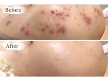 ピュリフィケーション(Purification)の雰囲気（なかなか改善しない肌荒れは次世代バイオピ－リングでOK♪）