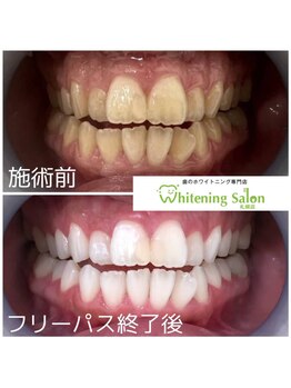 ホワイトニングサロン 札幌店/【ホワイトニング】#札幌#大通り