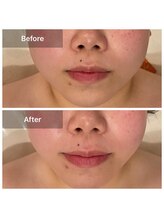 シャラ(SHARA)/【5D超音波】小顔、リフトアップ