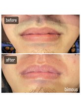 ビモアス(bimous)/人気のヒゲ脱毛