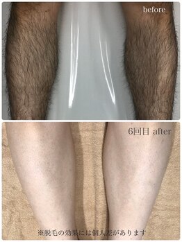 コモレビ(comorebi)/足脱毛その２（経過画像）