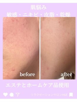 エイチ アンド イー(H&E)/