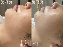 リツ(Ritsu)/二重顎/リフトアップ/LDM