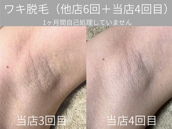 グランビューティーサロン(grand beauty salon)/ワキ脱毛