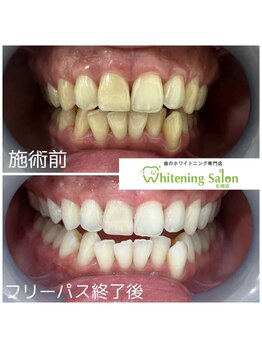 ホワイトニングサロン 札幌店/【ホワイトニング】#札幌#大通り