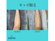 アクト クロ(ACT curro)/【キッズ】脱毛施術例