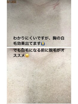 エピラージュ 町田店/全身脱毛