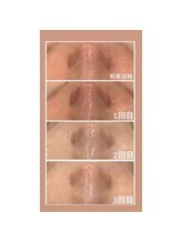 エステサロン ヴリエ 立川店/陶肌トリートメント★3回結果