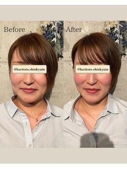 ハリトト鍼灸院/美容鍼灸 施術例 30代女性