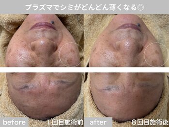 サロン ビュー(salon view)/70代女性〈シミ悩み〉