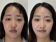 ベル(belle)/Before After