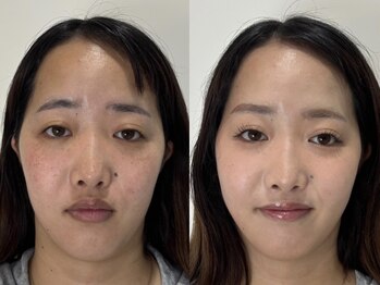 ベル(belle)/Before After