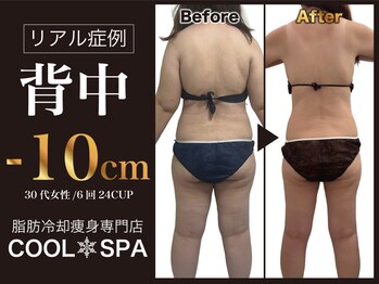 クールスパ(COOL SPA)の写真/ハミ肉なりやすい背中に脂肪冷却一択！3-5回でスッキリ背中へ