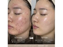 ココロ(COCORO)の雰囲気（肌トラブルでお悩みの方必見★ニキビ以外にもご相談ください）